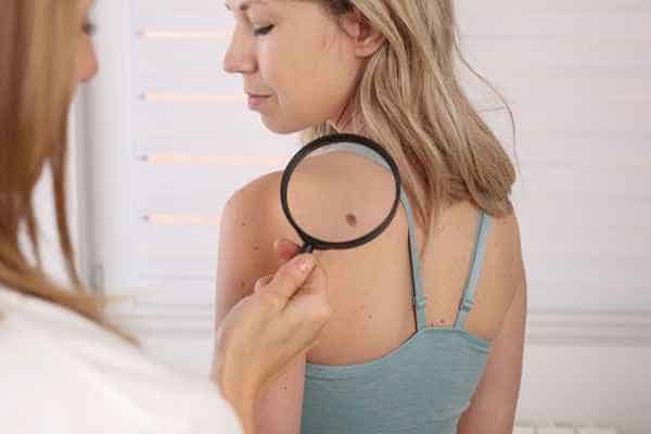 What Are Traditional Skin Lesion Removal Methods Cannock?