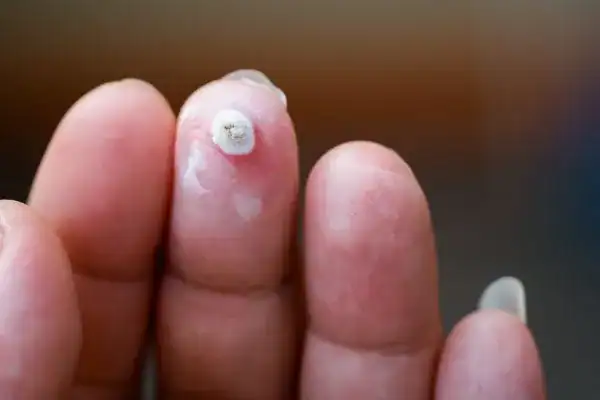 Image of white wart before cryopen treatment Cannock