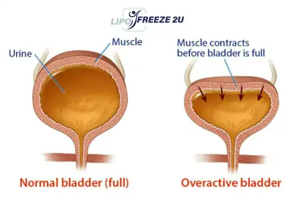 diagram of overactive bladder treatment Cannock
