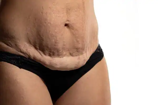 loose skin after weight loss injections Cannock