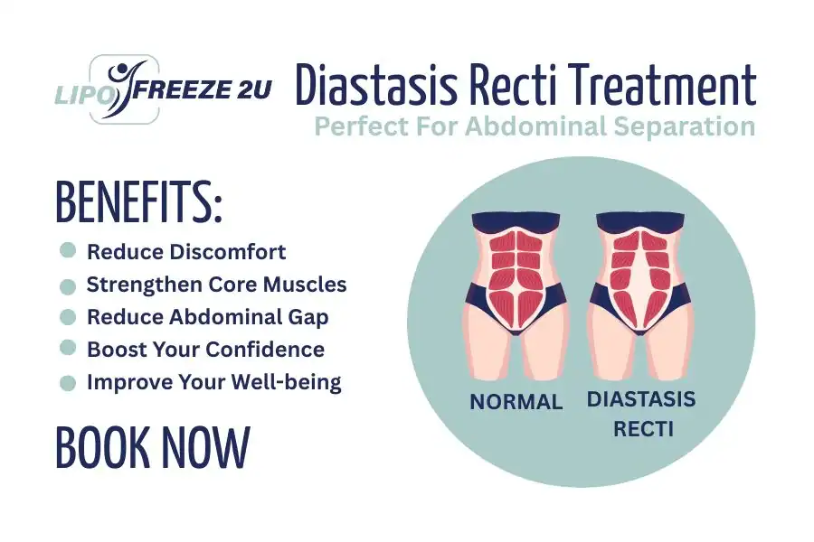 Benefits of body toning treatment Cannock for Diastasis recti