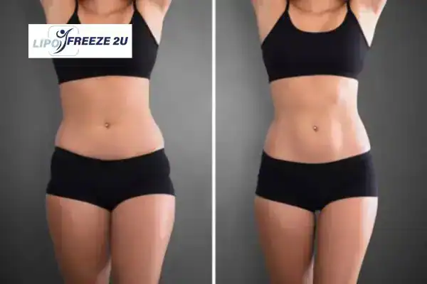 How Can LIPO FREEZE 2U Support Your Post-Pregnancy Body Recovery Cannock?