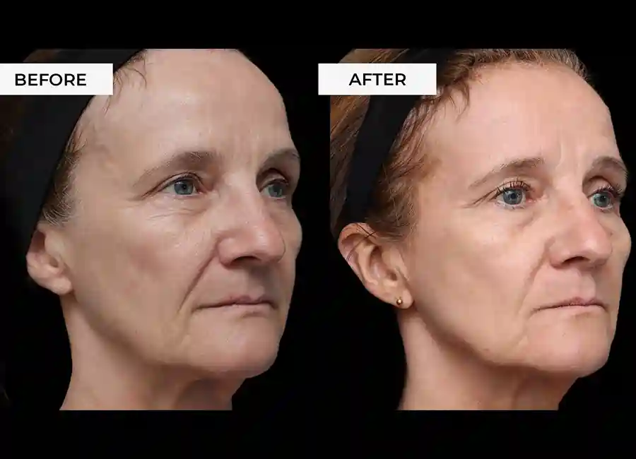 How Many RF Microneedling Sessions Will You Need to See a Difference Cannock?