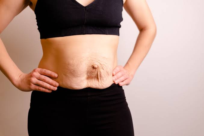 Is Surgery Really the Only Way to Repair Diastasis Recti Cannock?